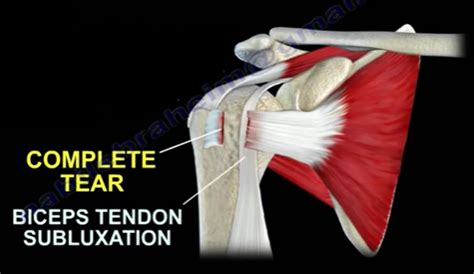 subscapularis tendon tear recovery time